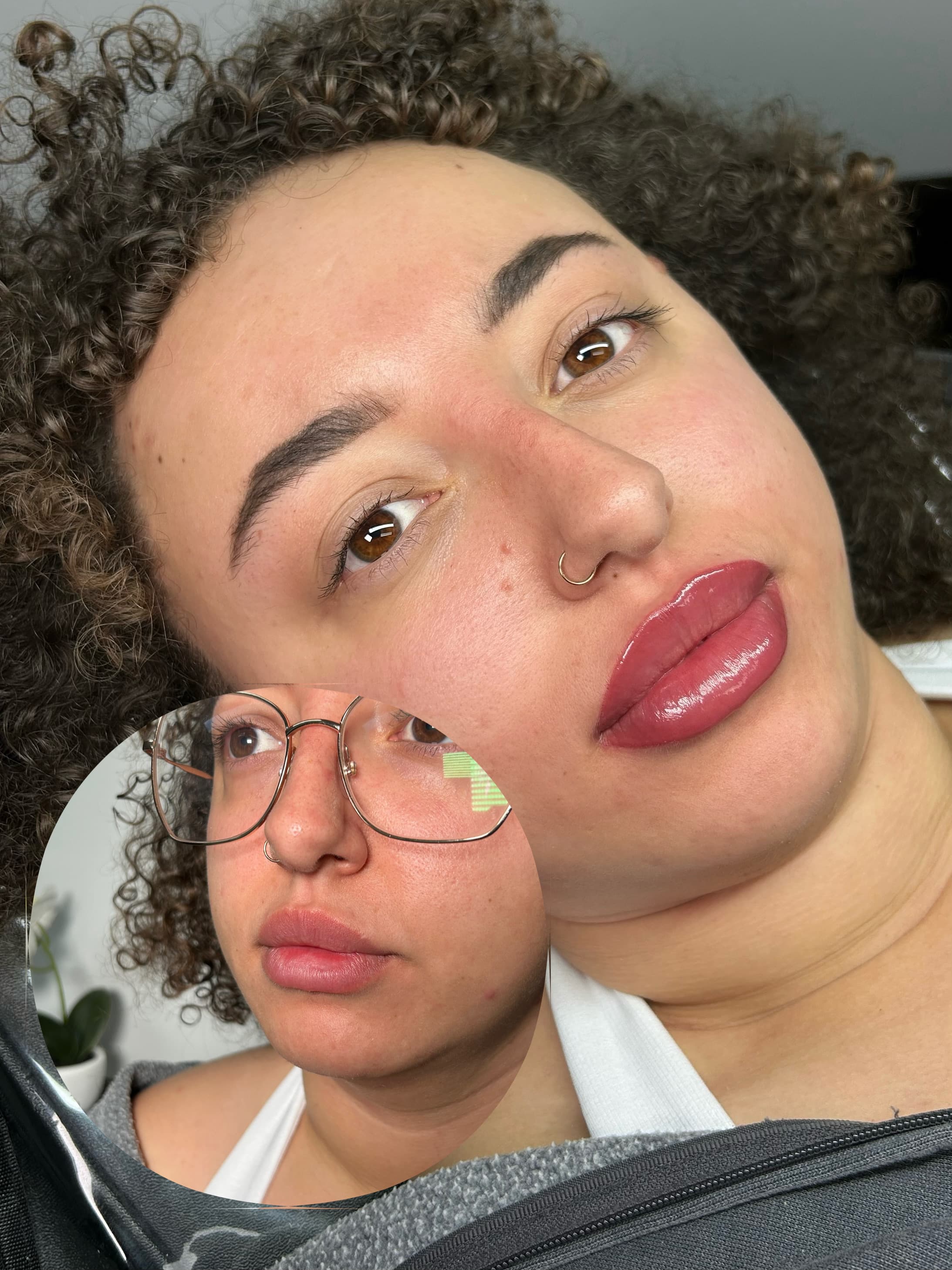 Lip filler before and after