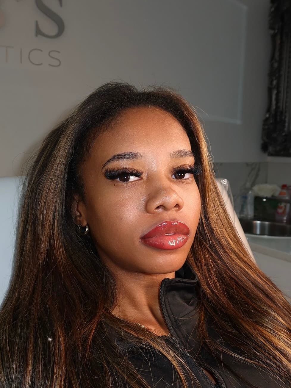 Lip filler result